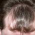 Особенности пересадки волос